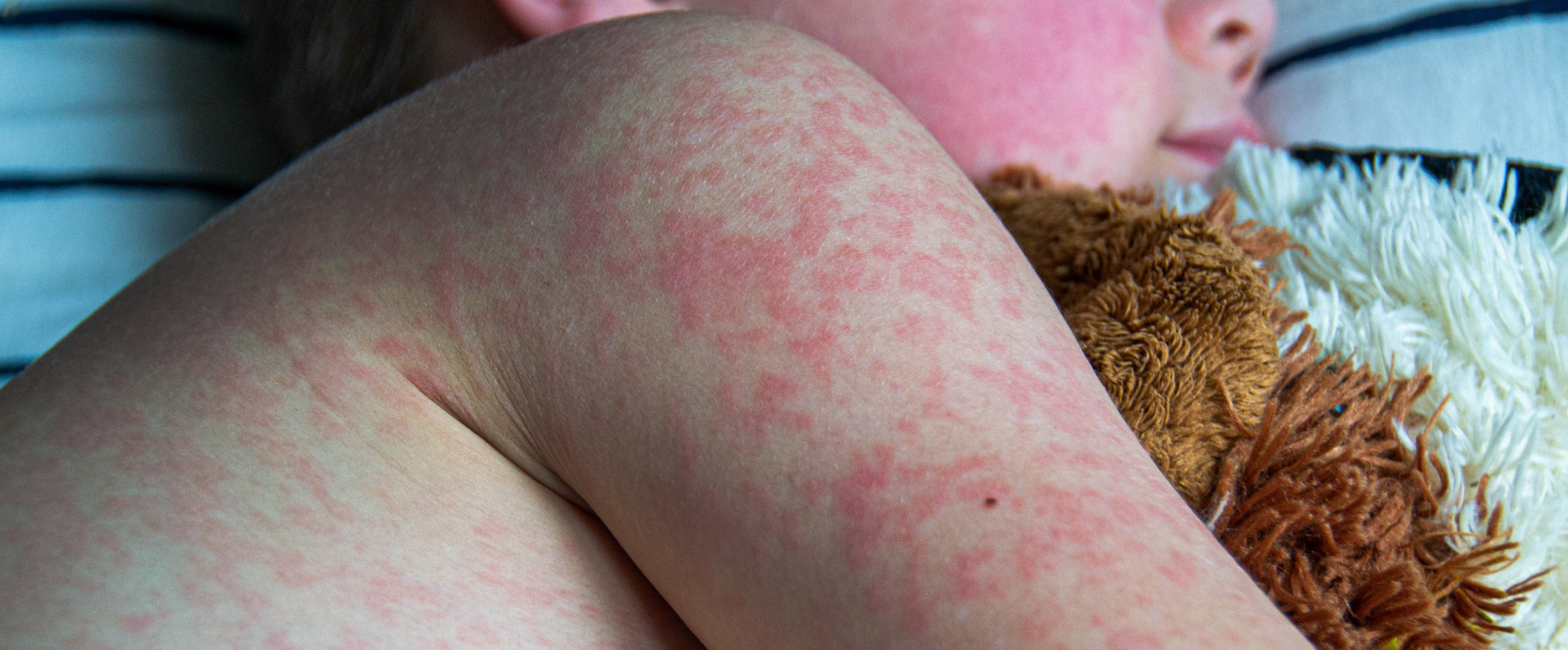 Measles in Children: Causes, Symptoms, Treatment and Prevention