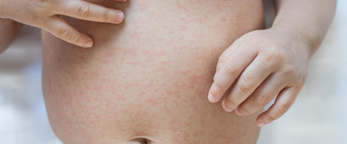 Heat Rash in Babies: Causes, Care Tips and Prevention