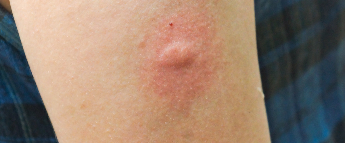 When Should You Worry About Insect Bites in Children?