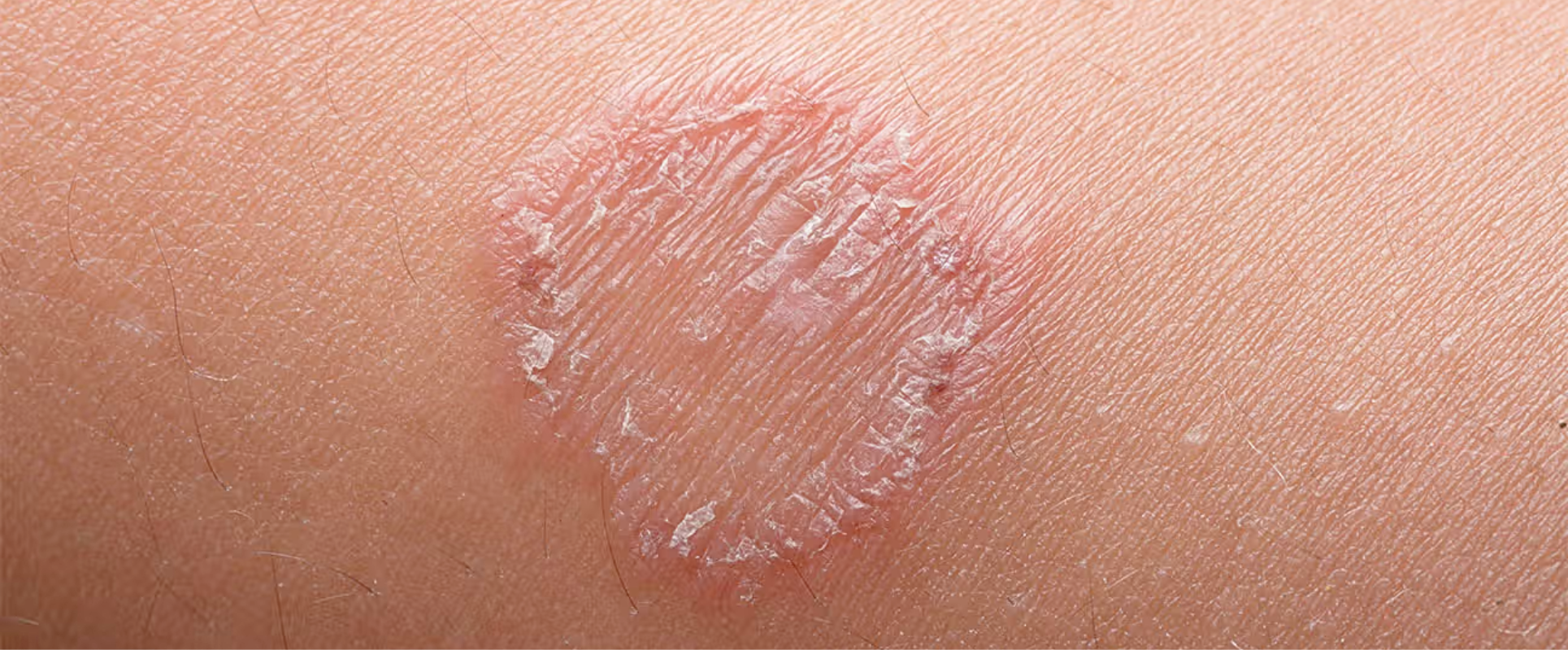 Fungal Skin Infections in Children: Causes, Symptoms and Safe Treatments